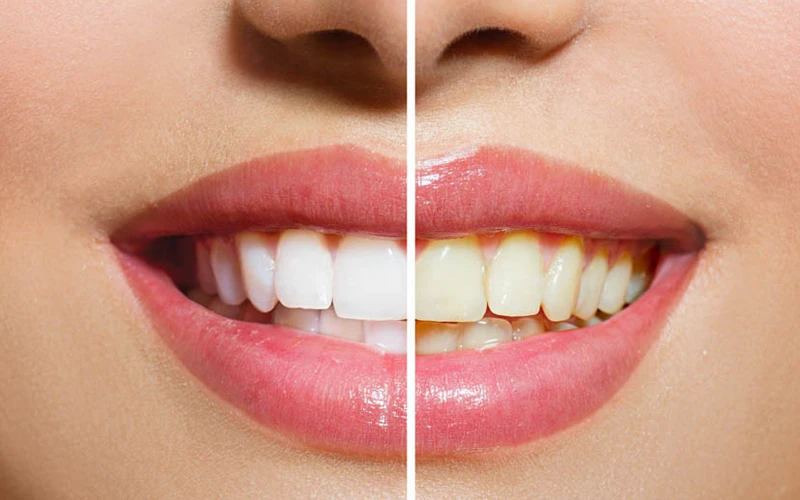 zahnarzt_viernheim_bleaching_klein